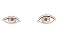 埋没法の失敗例：左右で目の大きさが異なる